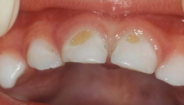 علاج تسوس الأسنان بالطرق الطبيعية