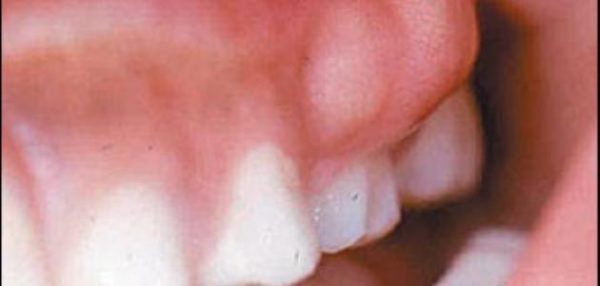 الوقاية من الإصابة بخراج الأسنان