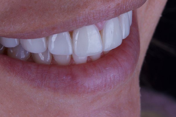 مميزات تلبيس الأسنان بعد سحب العصب